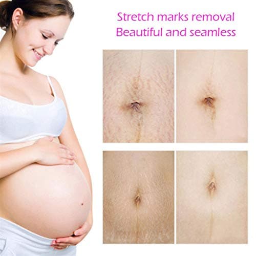 Sunshinehomely TCM Scar Cream, Acne Scar Removal Cream, Skin Repair Scars Burns Cuts Pregnancy Stretch Marks Cream Fat Scar Striae Gravidarum Treatment