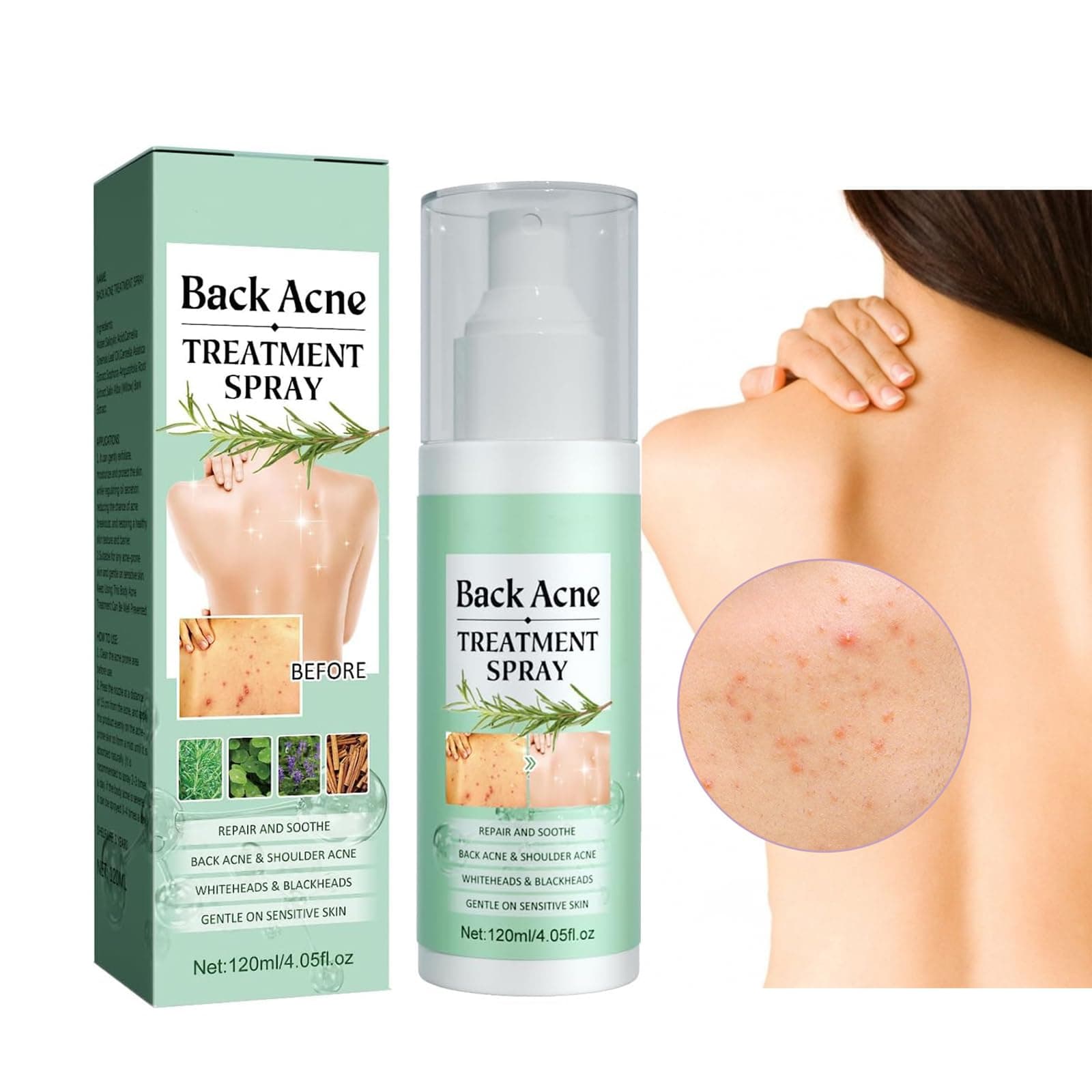 Back Acne Treatment Spray, Body Acne Spray Gentle Acne Oil Control Redness Smooth Skin Cleans Pores Moisturizes Easy to Use and Quick Dry Formula,Gentle on Skin, Repairs Chest & Butt Acne